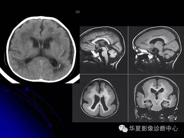 【PPT】颅脑先天发育畸形