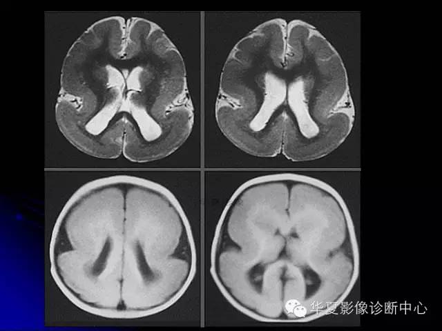 【PPT】颅脑先天发育畸形