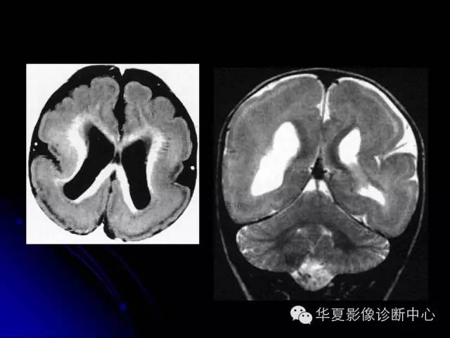 【PPT】颅脑先天发育畸形