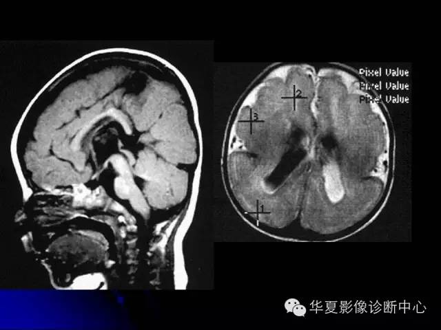 【PPT】颅脑先天发育畸形