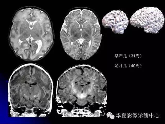 【PPT】颅脑先天发育畸形