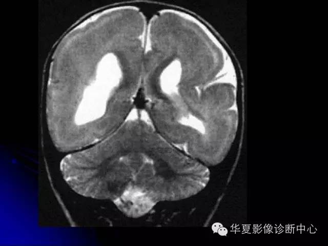 【PPT】颅脑先天发育畸形