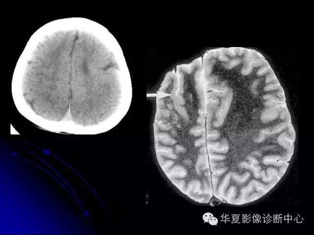 【PPT】颅脑先天发育畸形