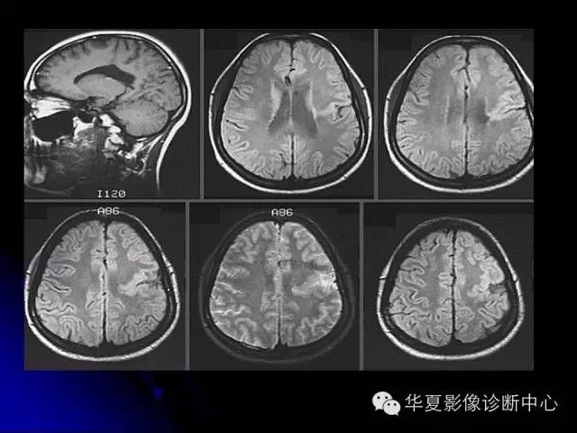 【PPT】颅脑先天发育畸形