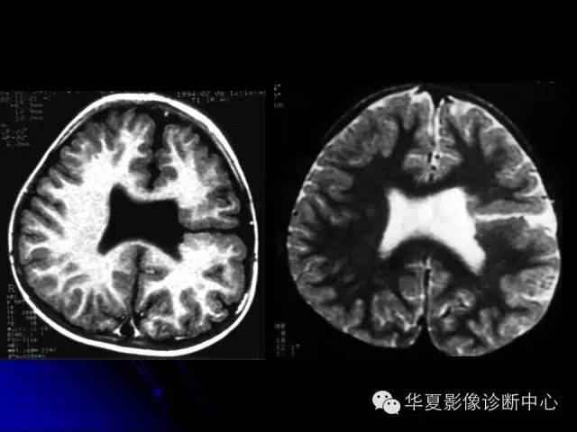 【PPT】颅脑先天发育畸形