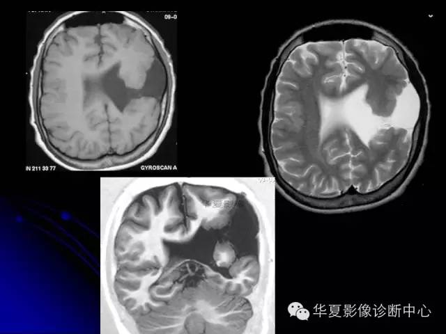 【PPT】颅脑先天发育畸形