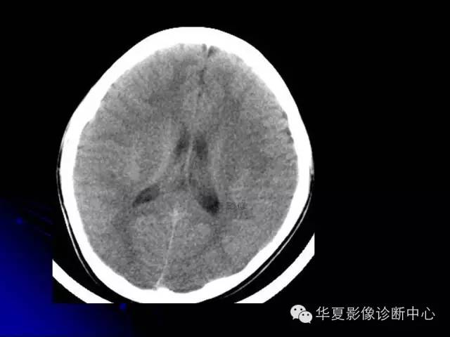 【PPT】颅脑先天发育畸形
