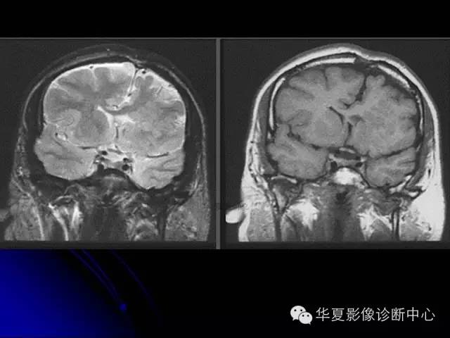 【PPT】颅脑先天发育畸形