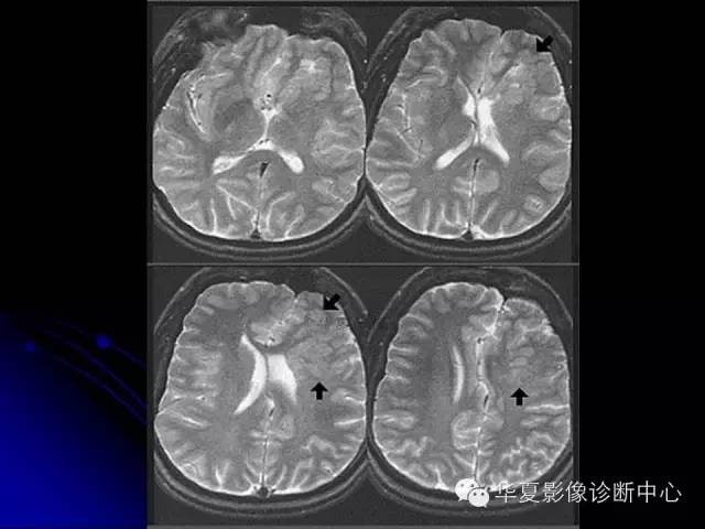 【PPT】颅脑先天发育畸形