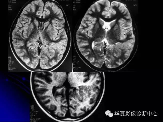 【PPT】颅脑先天发育畸形