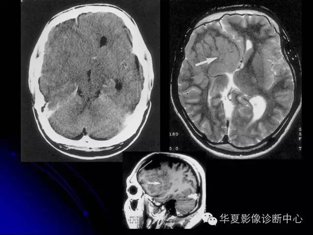 【PPT】颅脑先天发育畸形