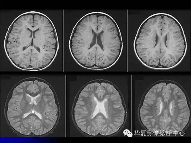 【PPT】颅脑先天发育畸形