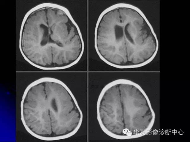 【PPT】颅脑先天发育畸形