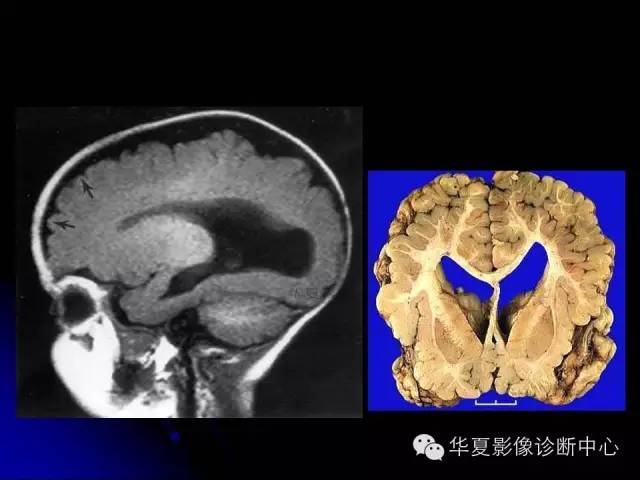 【PPT】颅脑先天发育畸形