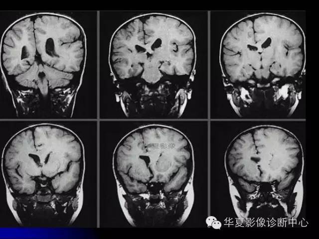 【PPT】颅脑先天发育畸形