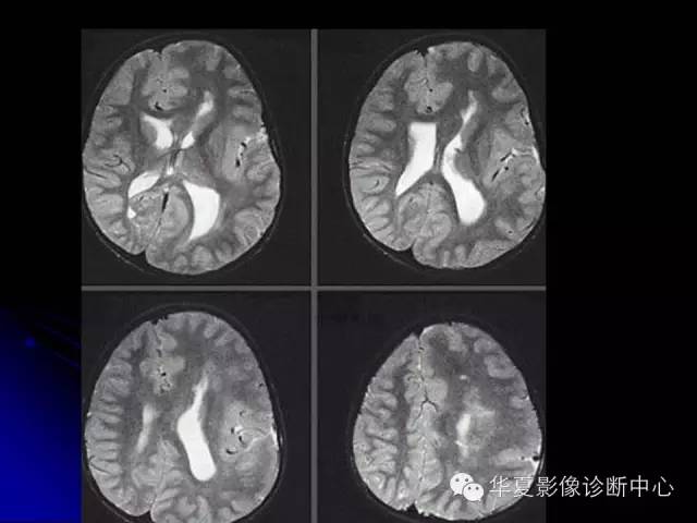 【PPT】颅脑先天发育畸形