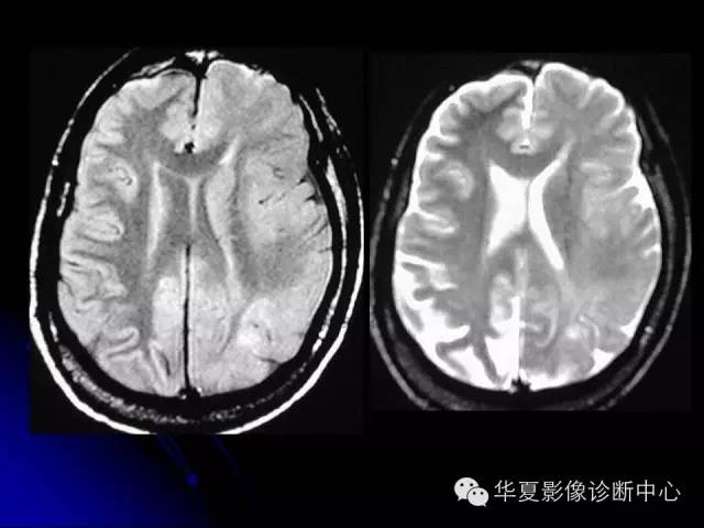 【PPT】颅脑先天发育畸形
