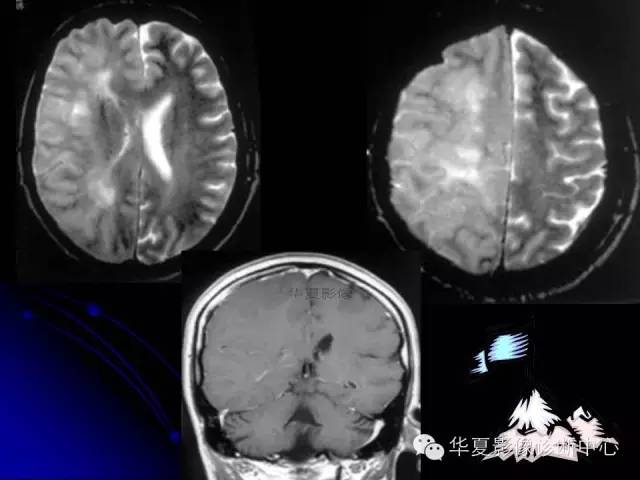 【PPT】颅脑先天发育畸形