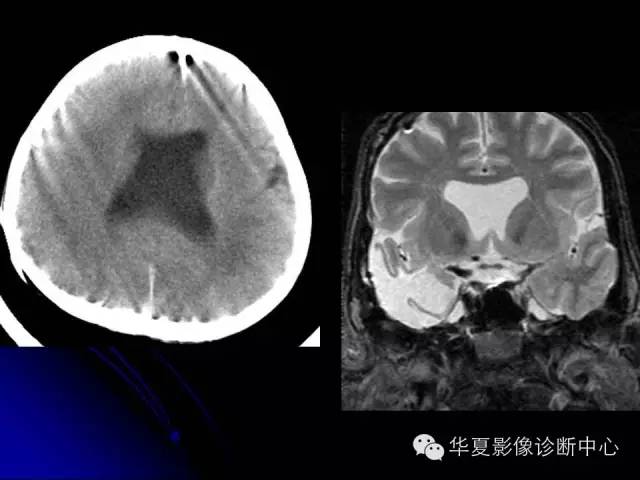 【PPT】颅脑先天发育畸形