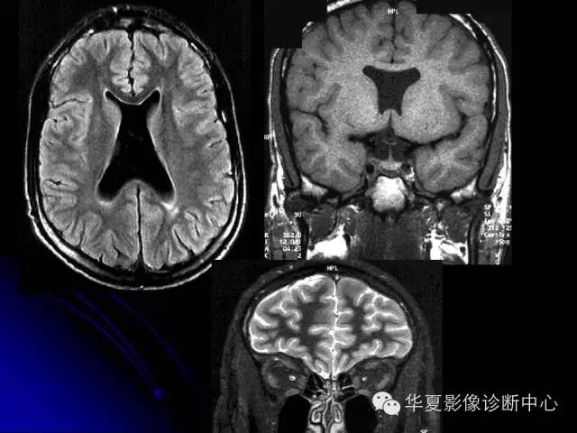 【PPT】颅脑先天发育畸形