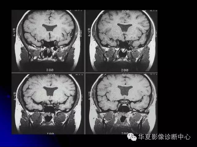 【PPT】颅脑先天发育畸形