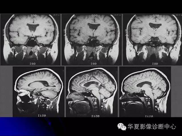 【PPT】颅脑先天发育畸形