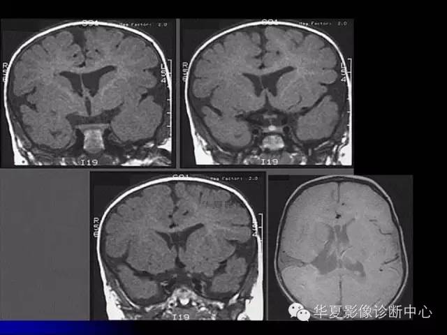 【PPT】颅脑先天发育畸形