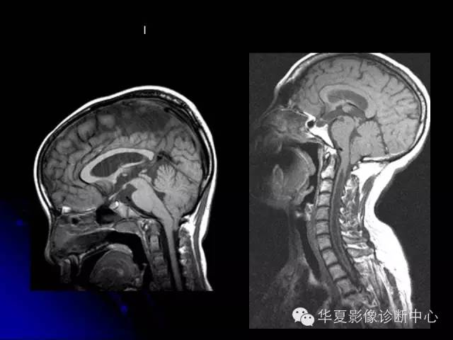 【PPT】颅脑先天发育畸形