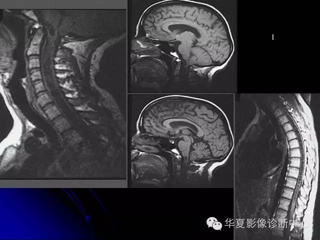 【PPT】颅脑先天发育畸形