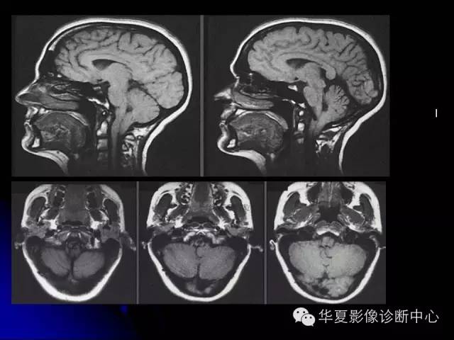 【PPT】颅脑先天发育畸形