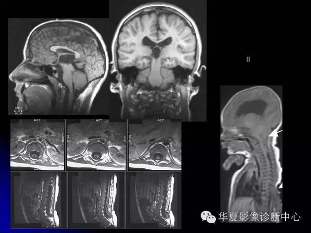 【PPT】颅脑先天发育畸形