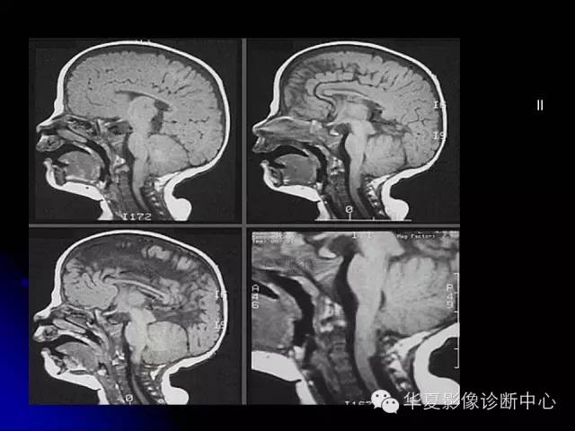 【PPT】颅脑先天发育畸形