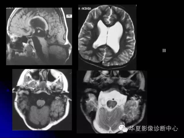【PPT】颅脑先天发育畸形