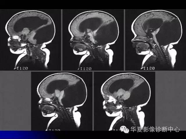 【PPT】颅脑先天发育畸形
