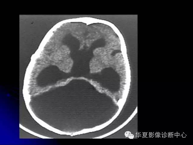 【PPT】颅脑先天发育畸形