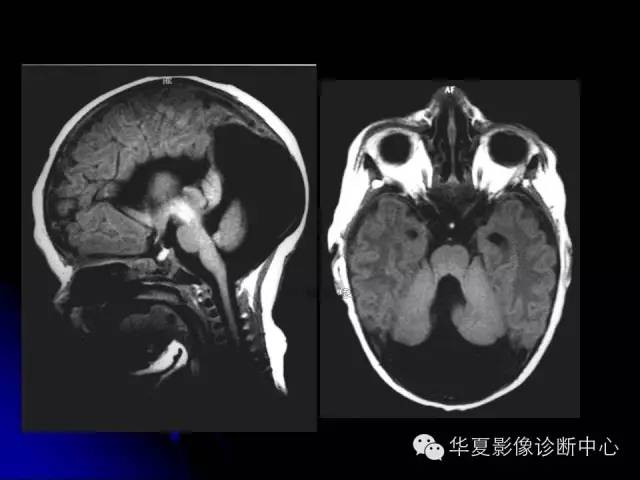 【PPT】颅脑先天发育畸形