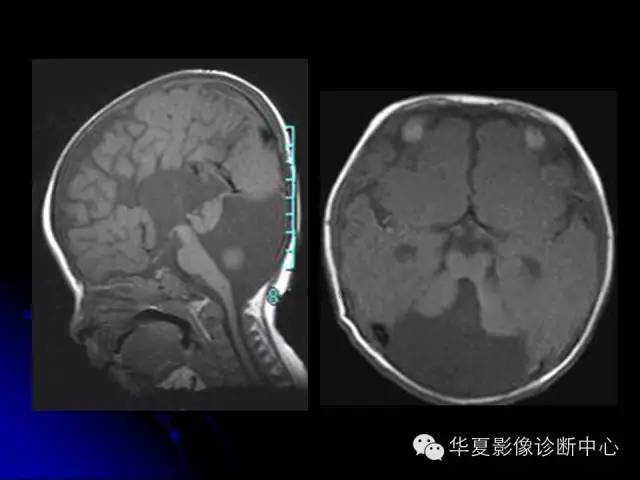 【PPT】颅脑先天发育畸形
