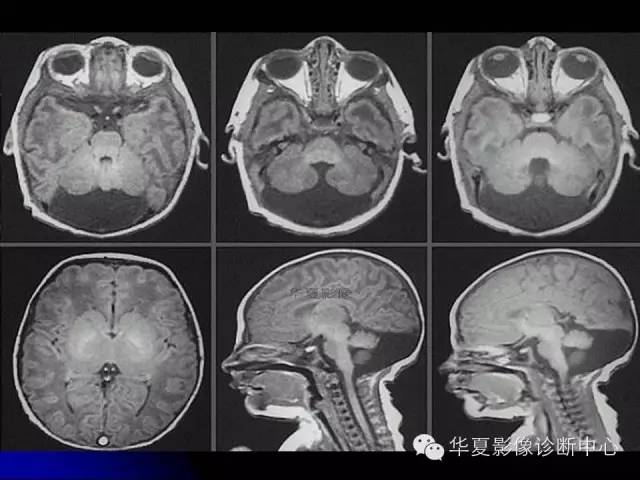 【PPT】颅脑先天发育畸形