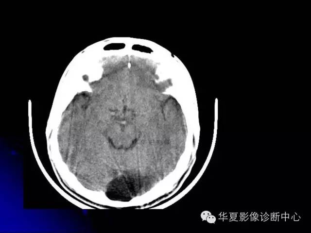 【PPT】颅脑先天发育畸形