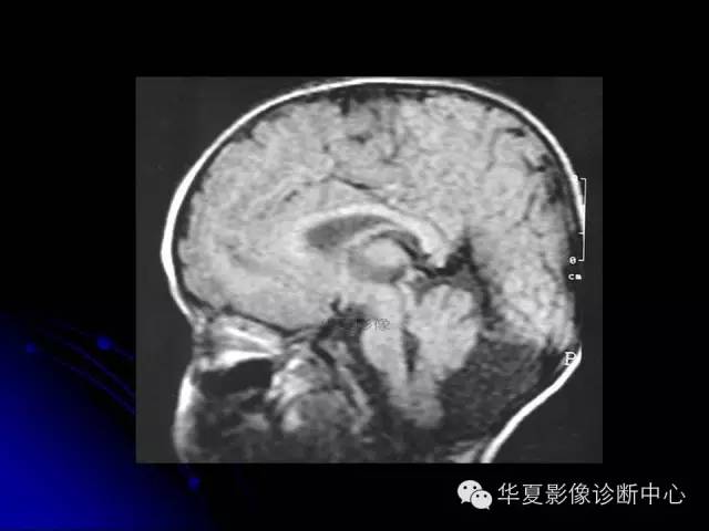 【PPT】颅脑先天发育畸形