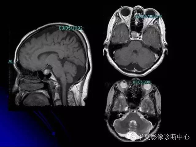 【PPT】颅脑先天发育畸形