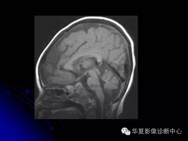【PPT】颅脑先天发育畸形