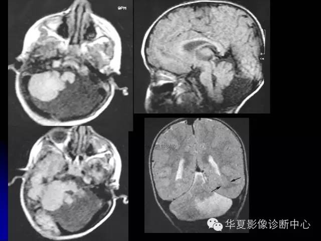 【PPT】颅脑先天发育畸形
