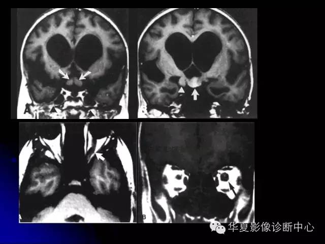 【PPT】颅脑先天发育畸形