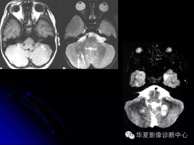 【PPT】颅脑先天发育畸形