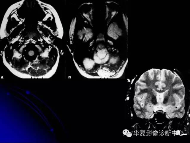 【PPT】颅脑先天发育畸形