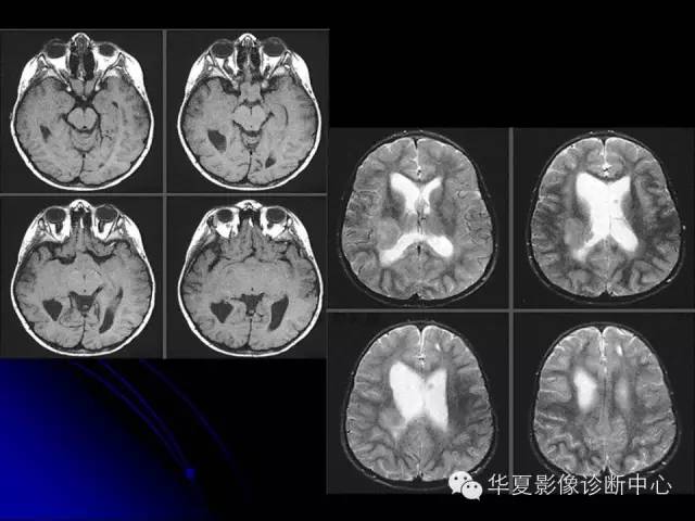 【PPT】颅脑先天发育畸形