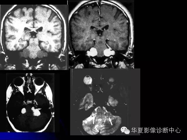 【PPT】颅脑先天发育畸形