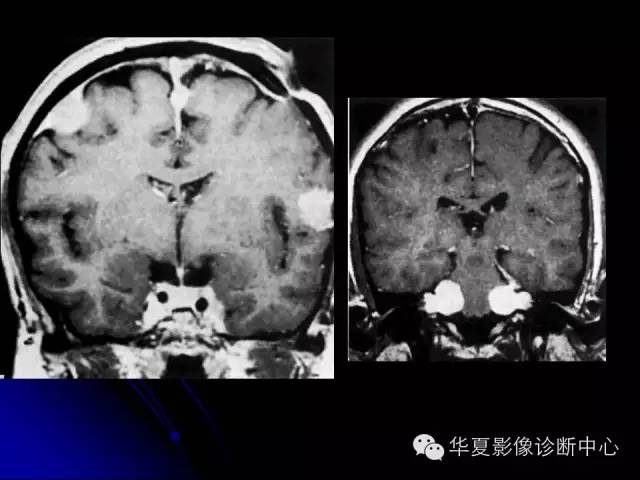 【PPT】颅脑先天发育畸形