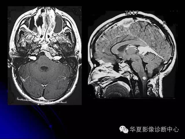 【PPT】颅脑先天发育畸形